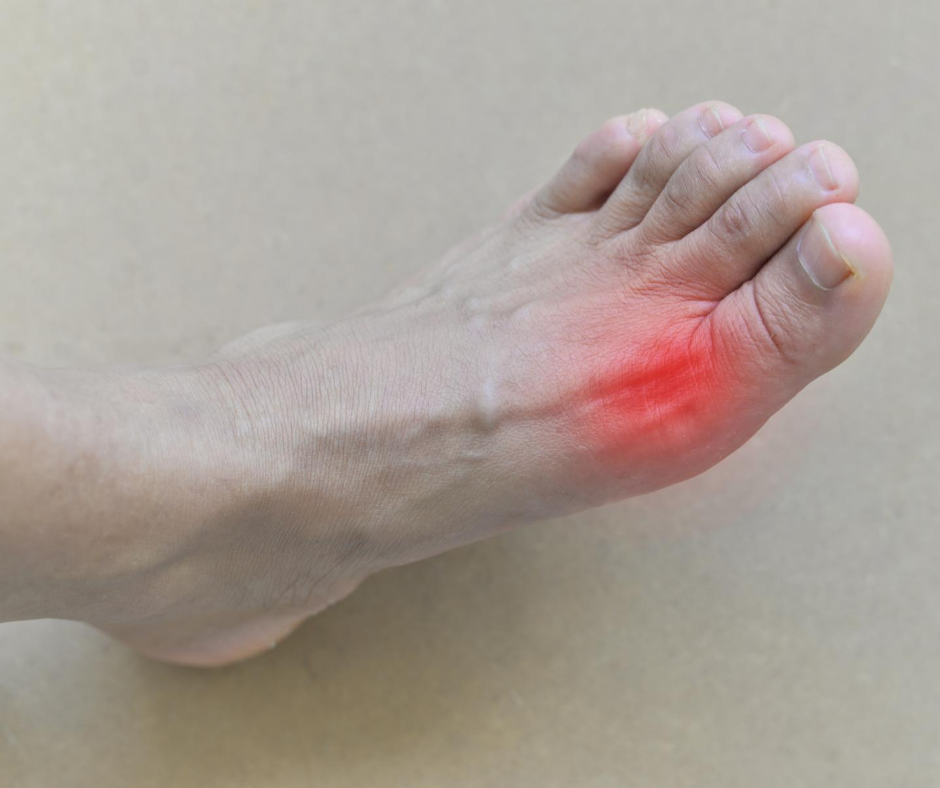 Gout Causes & Treatment – My FootDr