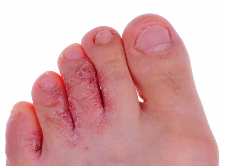 Athletes Foot Tinea Pedis My Footdr