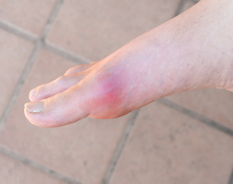 what-causes-severe-pain-in-the-ball-of-the-foot-my-footdr