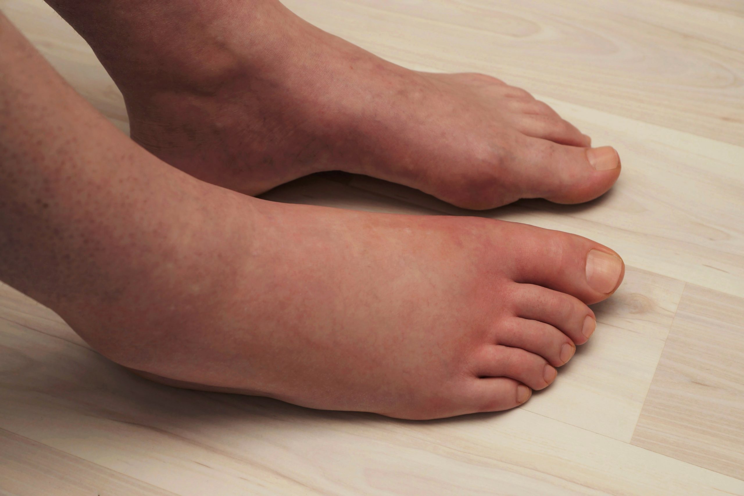 What Causes Swollen Feet And Ankles My Footdr