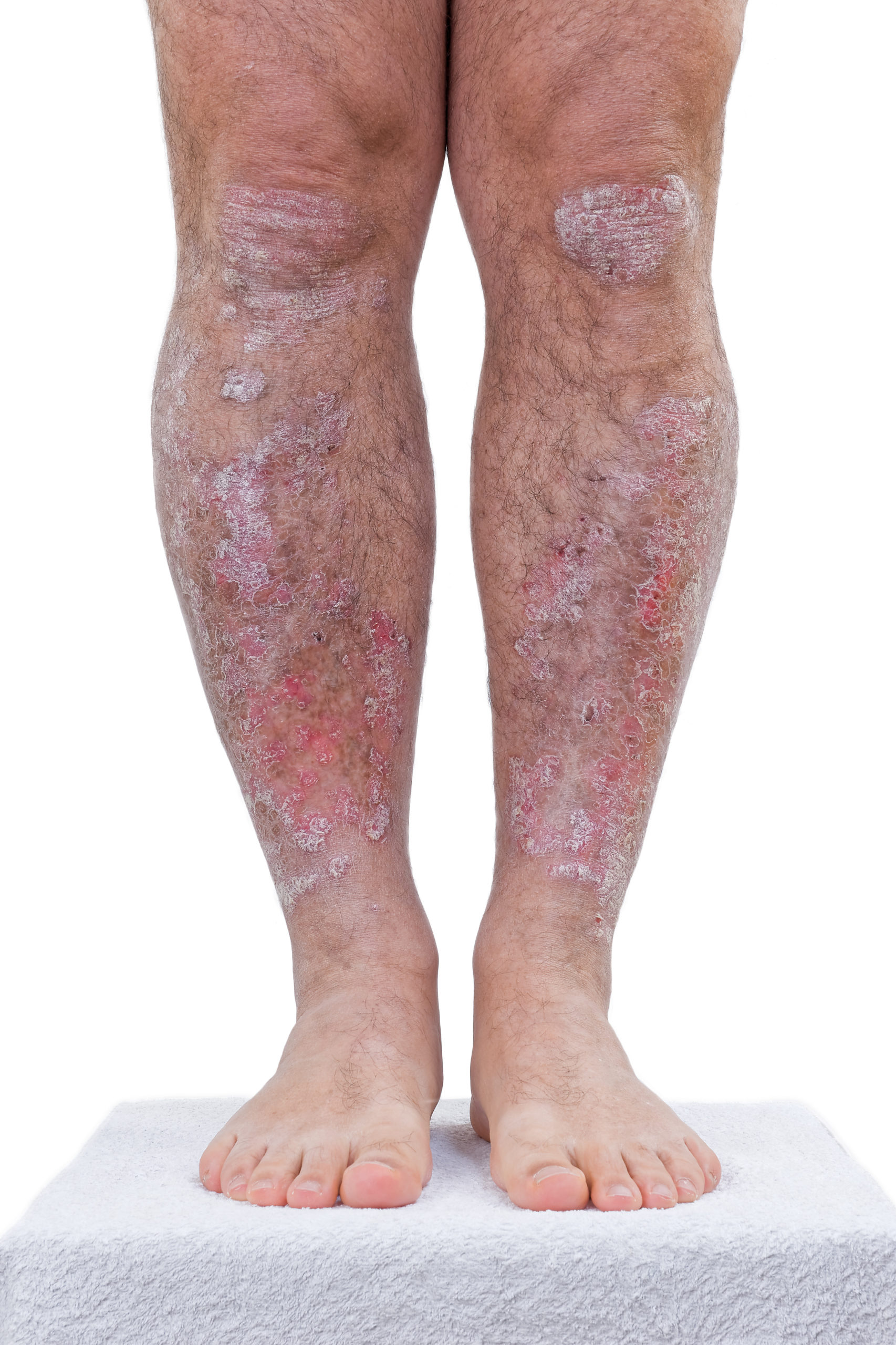 Psoriasis Causes & Treatment – My FootDr