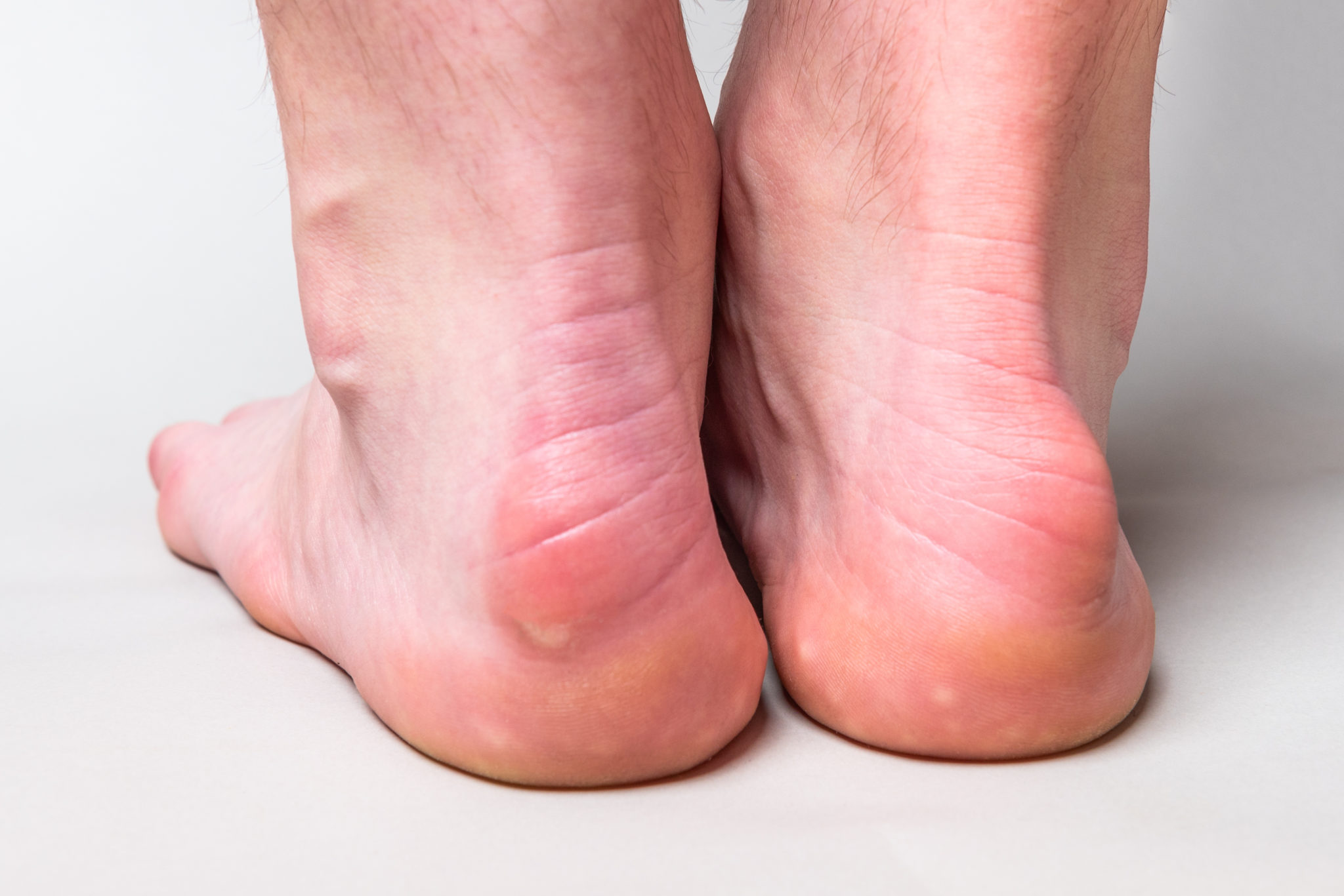 Haglunds Deformity Causes And Treatment My Footdr 4031