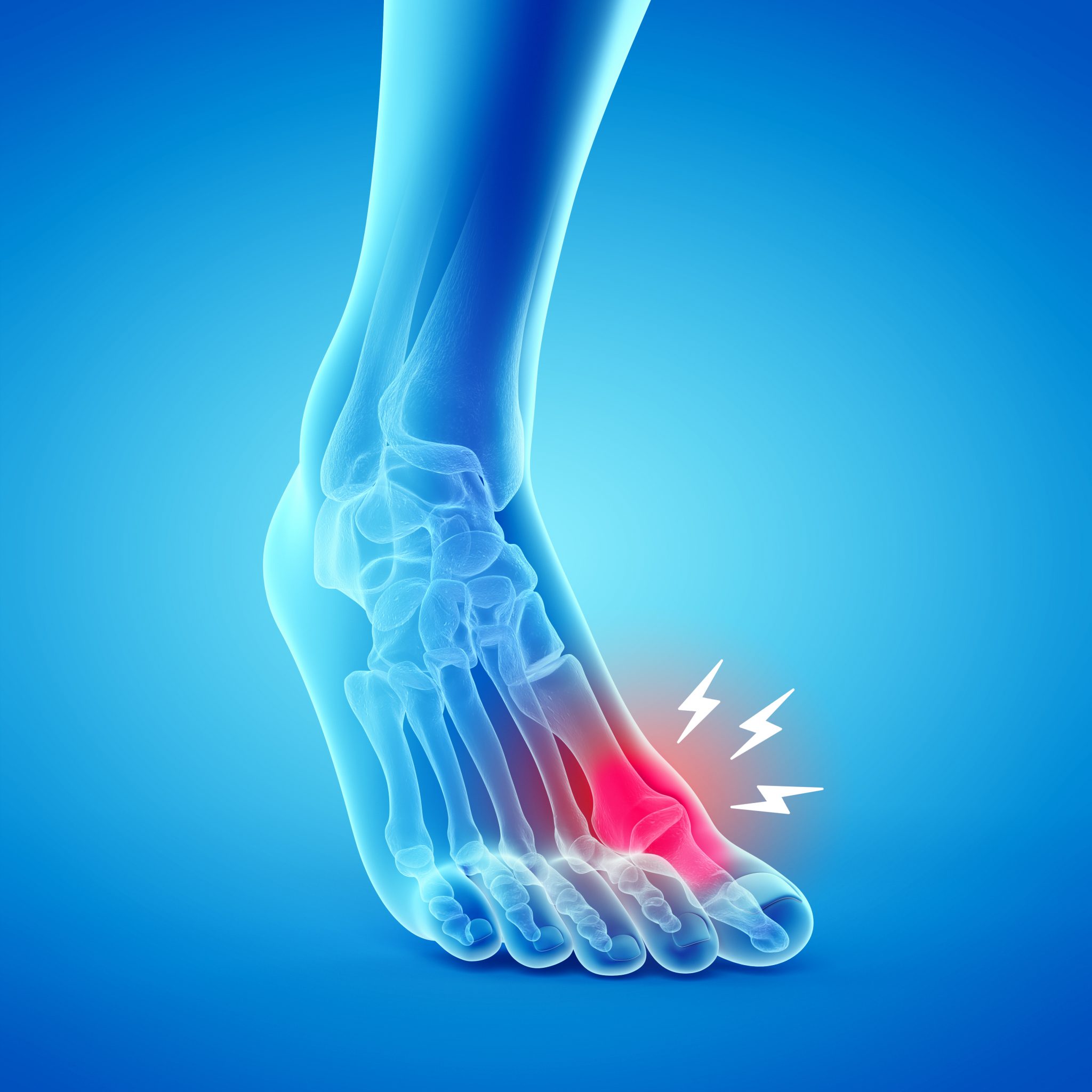 What Causes Gout In The Foot? My FootDr