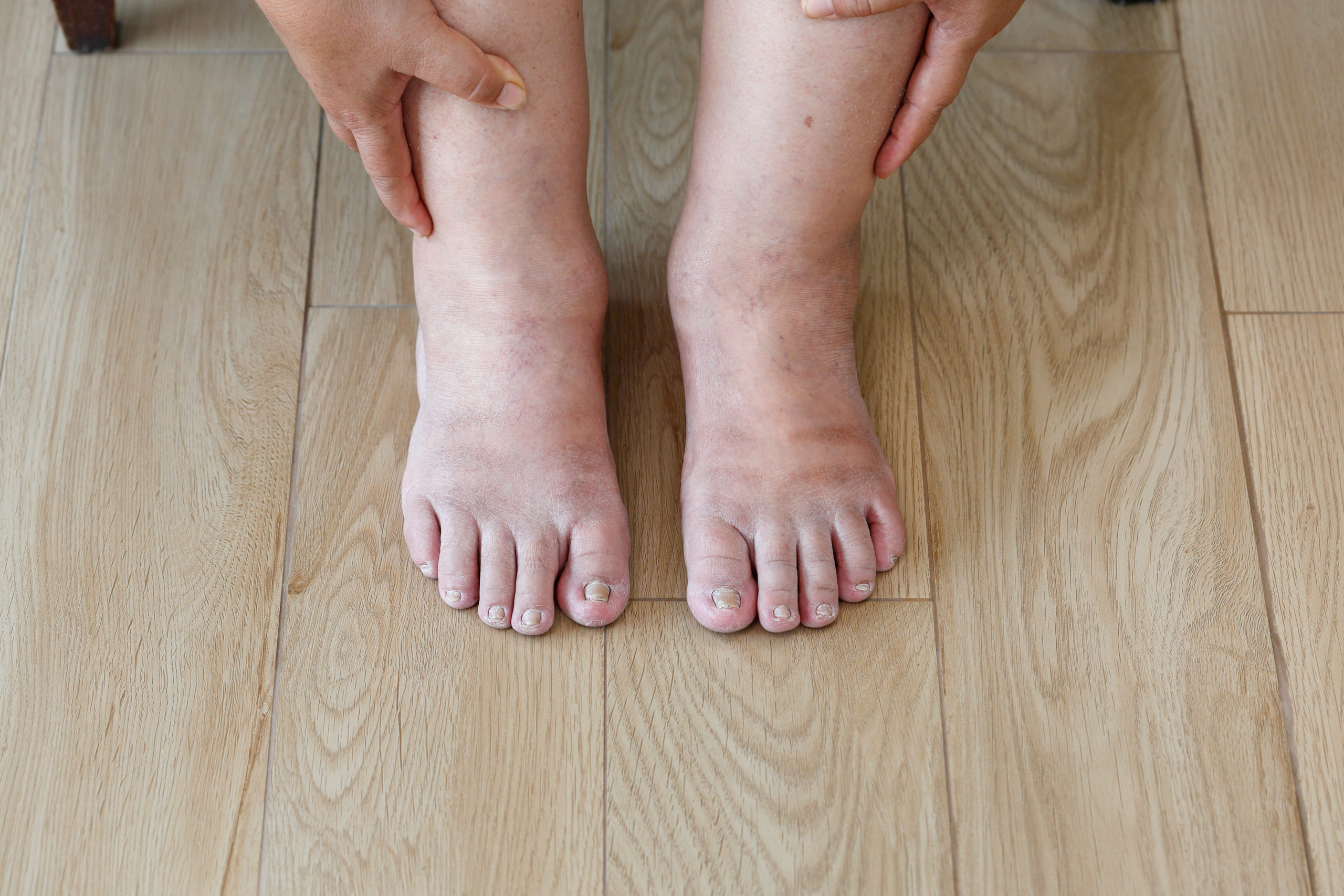 Swelling in feet? Know when to worry about it