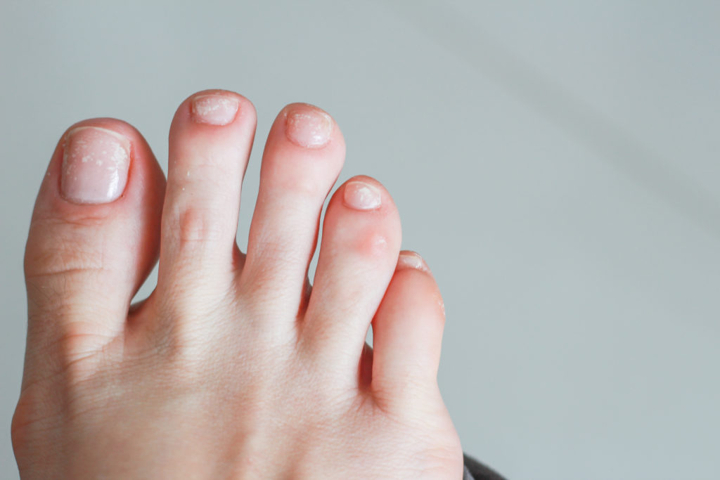 crusty toenails