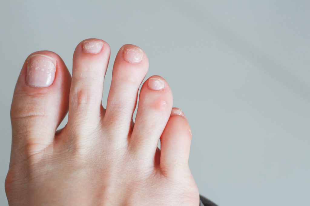 Causes Of White Spots On Your Toenails My FootDr