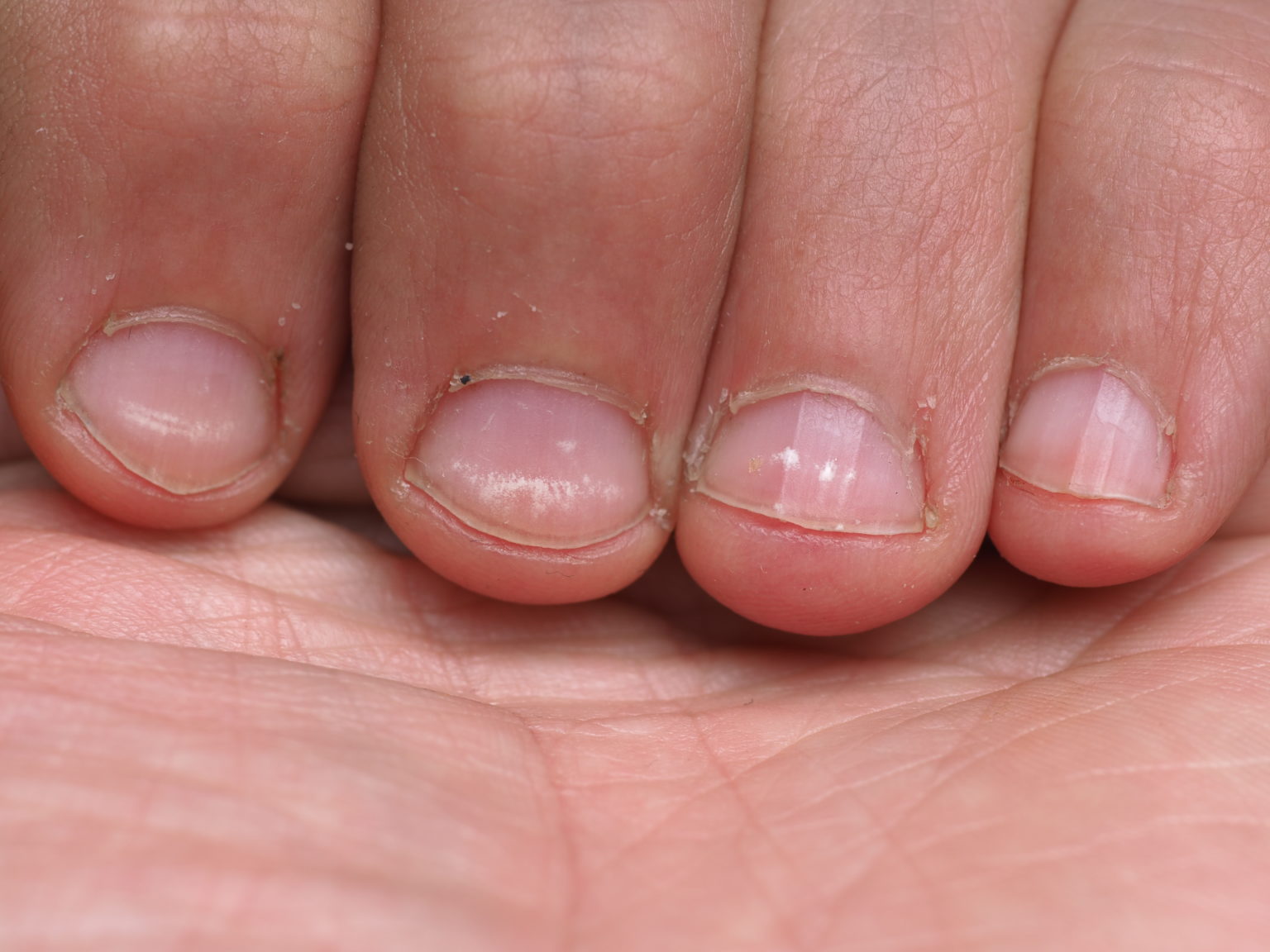 White Marks On Toenails Treatment