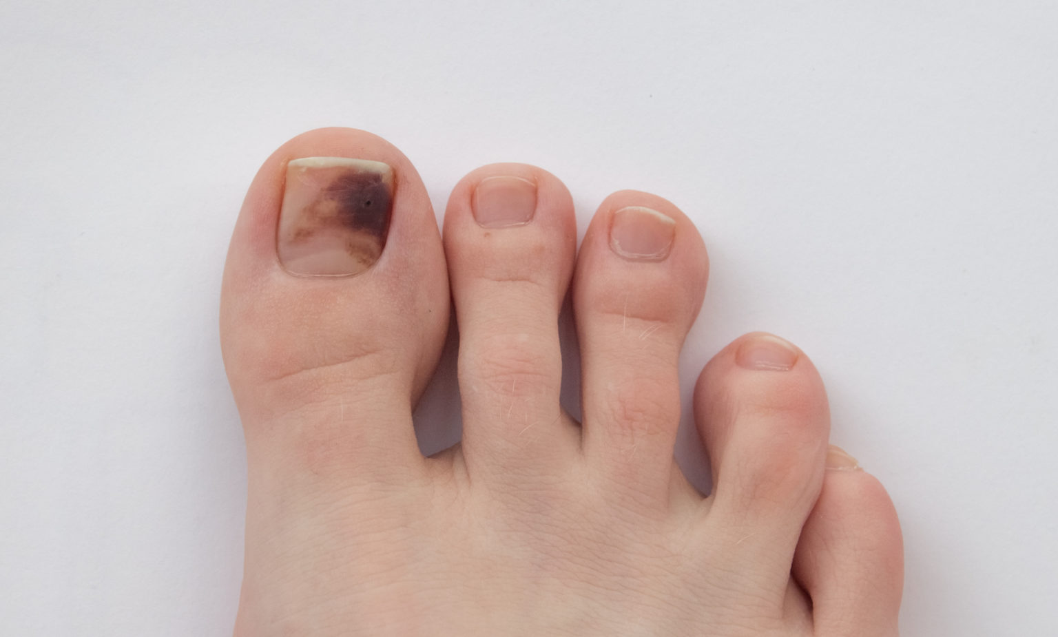 What S Causing The Black Spot Beneath My Nail My FootDr   AdobeStock 334499585 Nail Hematoma 1536x925 