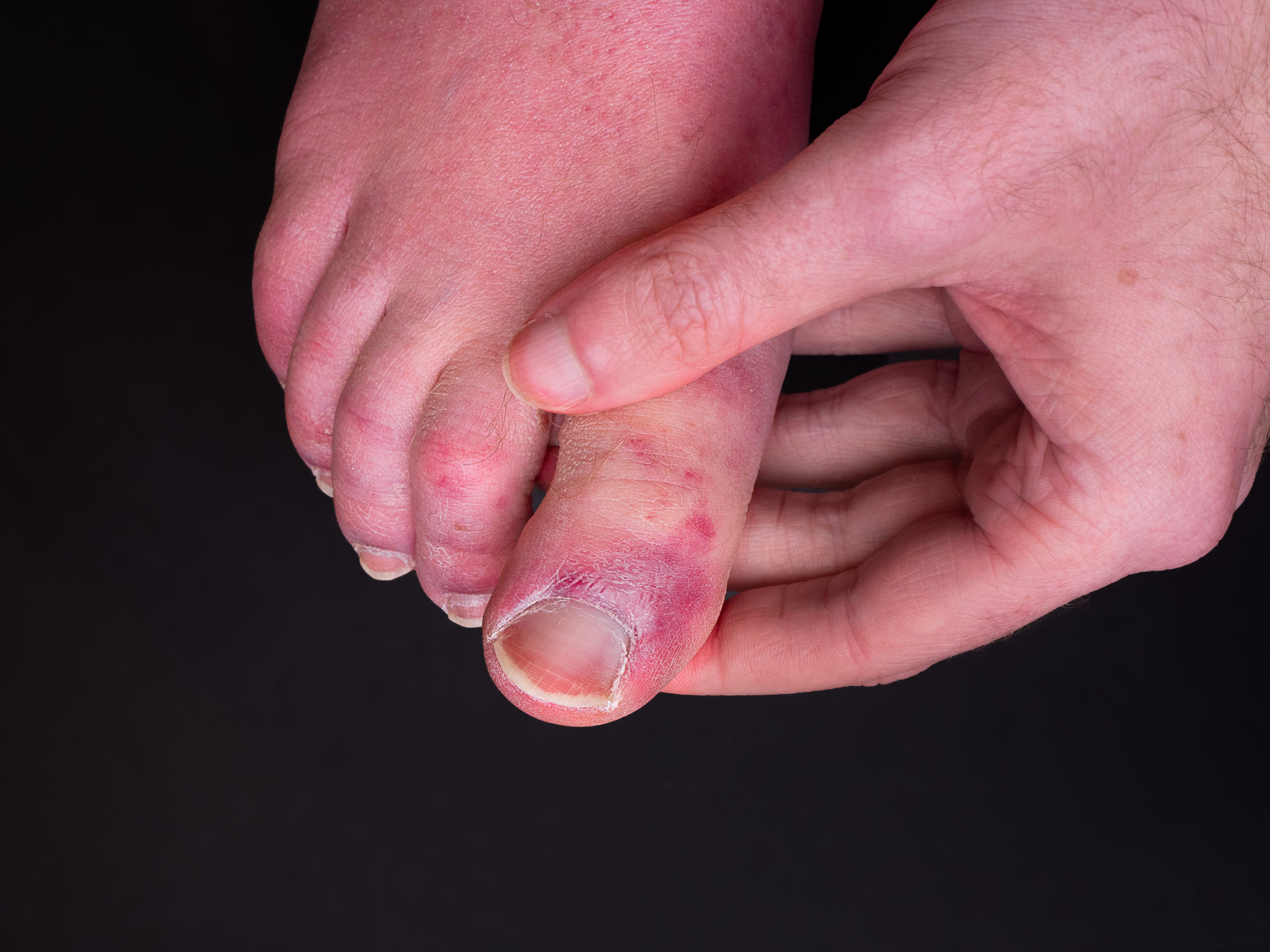 What causes red spots on the feet? Other symptoms and treatment