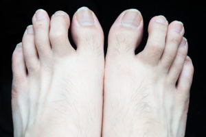 Ross Orthotics - You have all probably heard of the terms Hammer Toes, Claw  Toes, or Mallet Toes before, but do you know what the difference is? A Hammer  Toe bends down