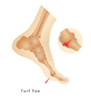 Turf Toe Causes & Symptoms – My FootDr