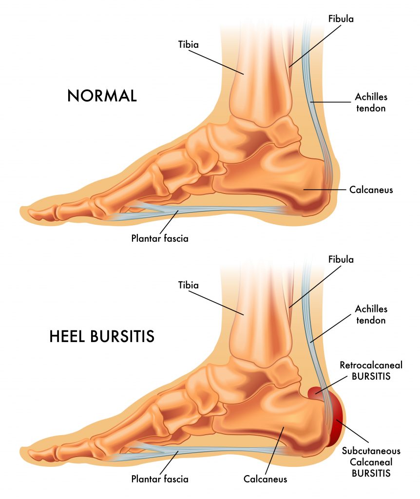 Bursitis Causes & Treatment – My FootDr