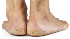 Cracked Heels Treatment – My FootDr