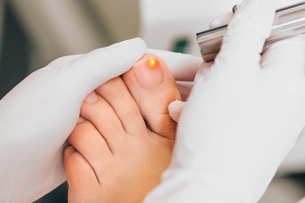 Fungal Nail Infection Laser Treatment My FootDr