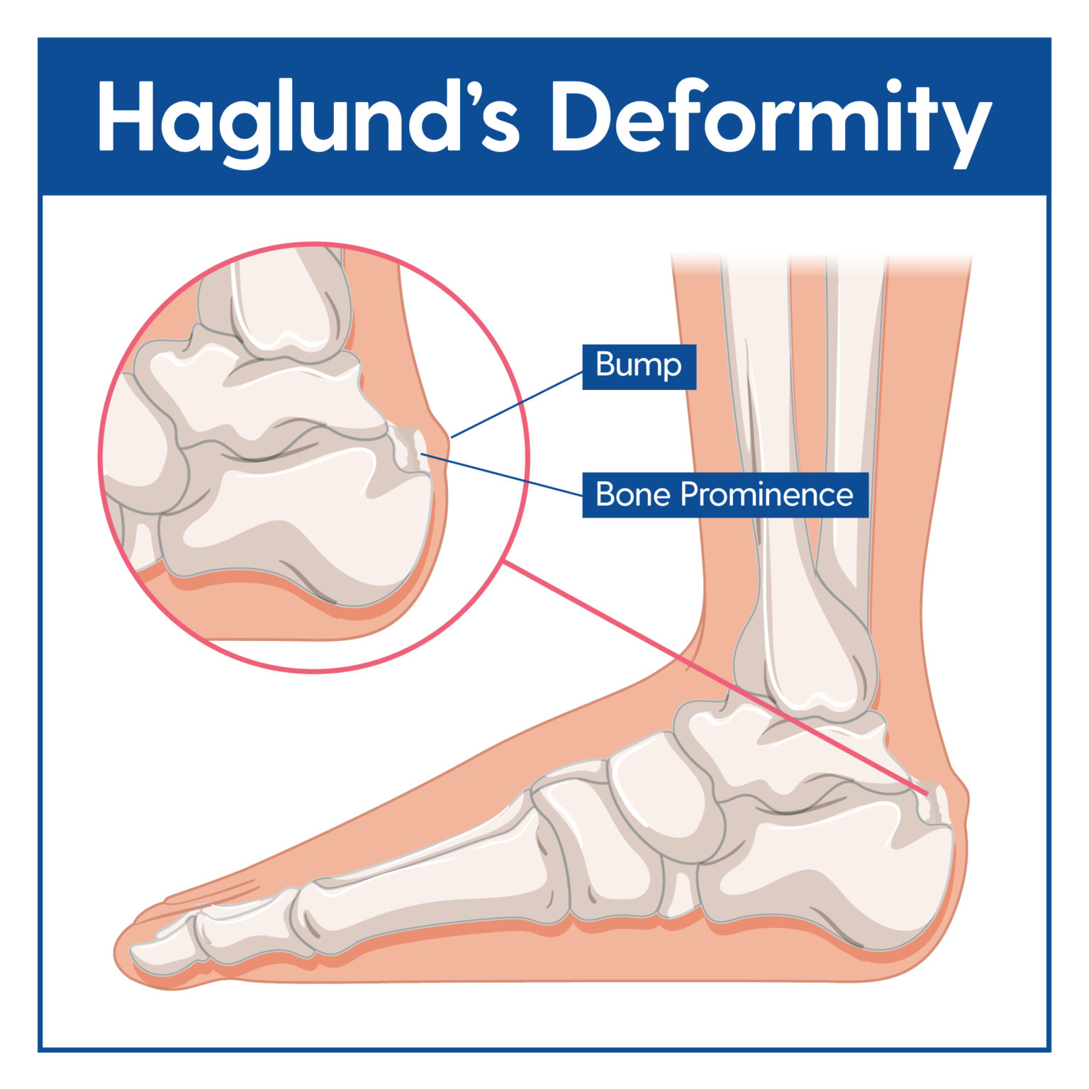 Haglunds Deformity Causes And Treatment My Footdr 