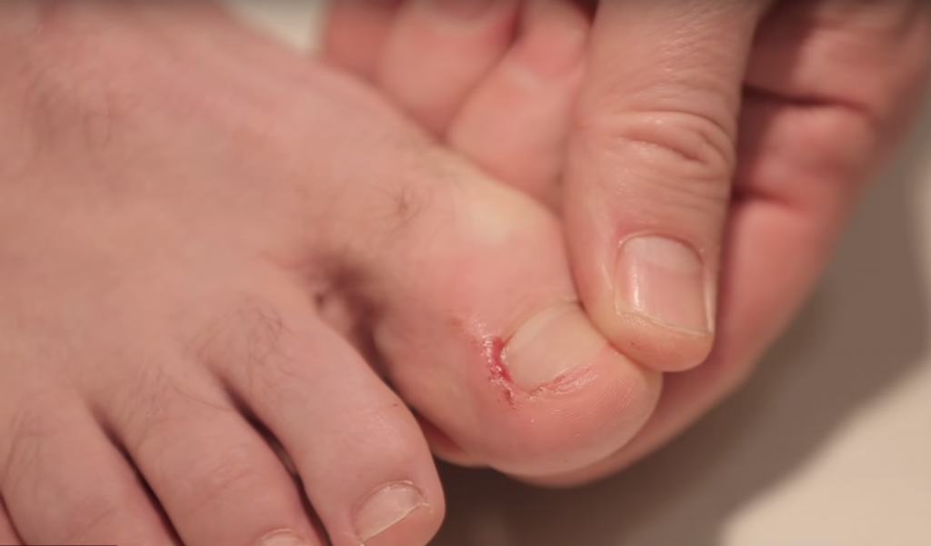 how-to-fix-a-ingrown-nail-matthews-shomire