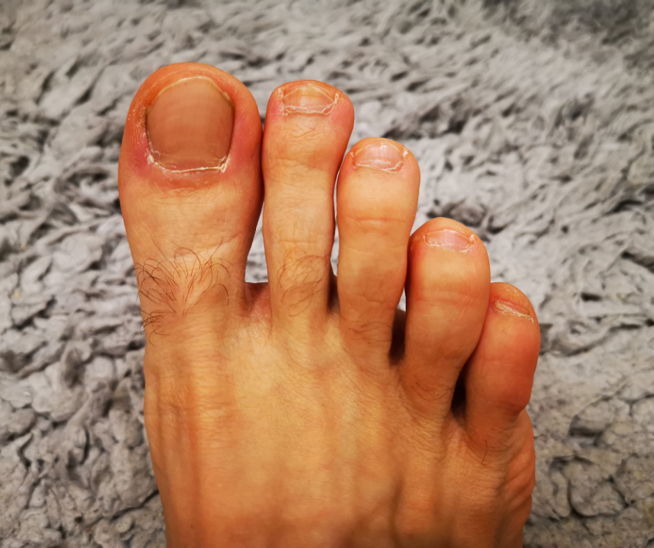 Why Are My Toes Red? – My FootDr