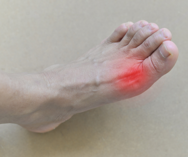 What Causes Gout In The Foot My Footdr 4439