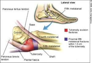 outside foot pain