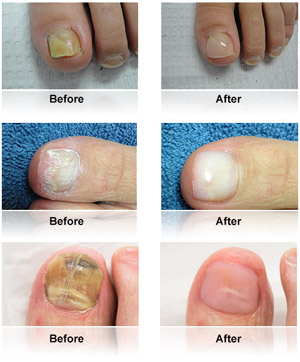 Cosmetic Nail Restoration – My FootDr