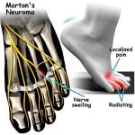 Morton’s Neuroma Symptoms & Treatment – My FootDr